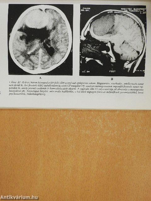 Sürgősség a Neurológiában