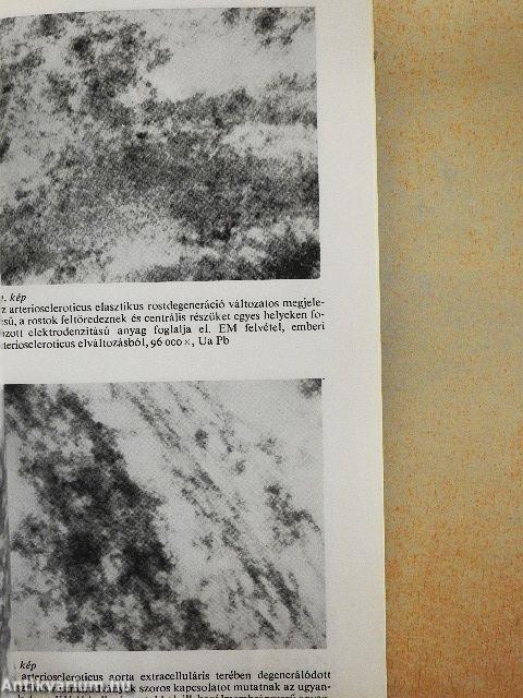 A kötőszövet patológiás szerkezetváltozásai arteriosclerosisban