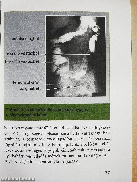 Gyulladásos bélbetegségek