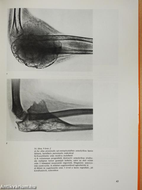 Csontdaganatok (kétszeresen dedikált példány)