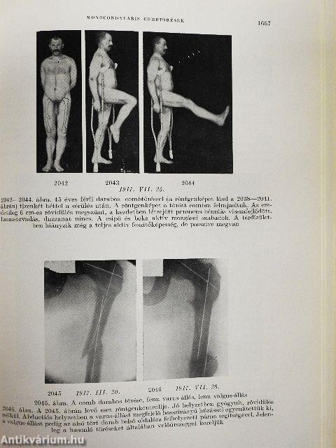 A csonttörések kezelése III.