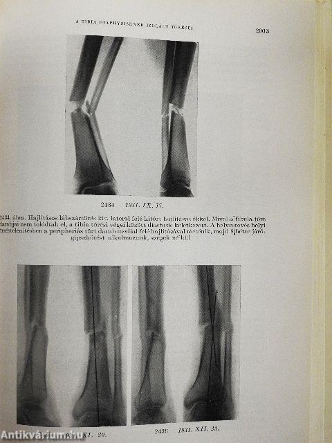 A csonttörések kezelése IV.