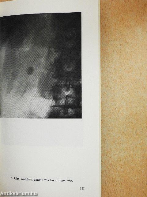 Vesekőről veseköveseknek