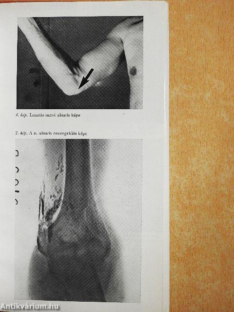 Alagút-szindrómák