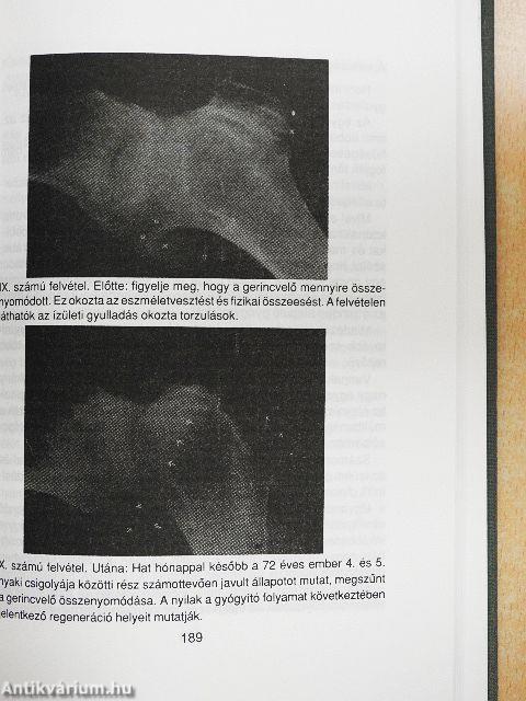 Egy orvos kipróbált, új házi gyógymódja az ízületi gyulladásra