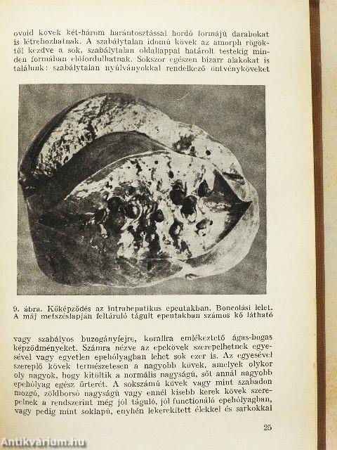 Az epekőbetegség és sebészi gyógyítása