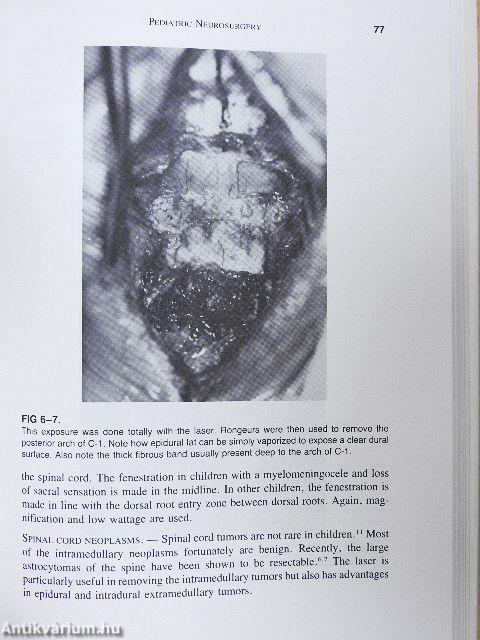 Application of Lasers in Neurosurgery