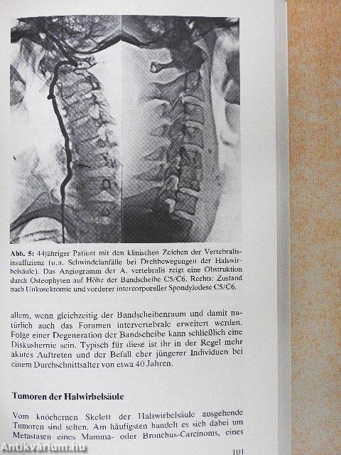 Nacken-Schulter-Arm-Syndrom