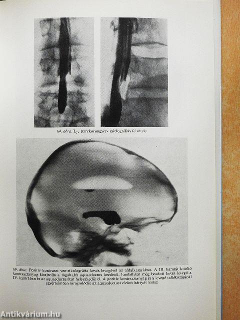 Operálható idegbetegségek