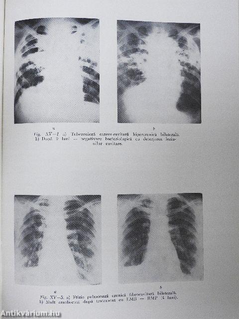 Terapia tuberculozei pulmonare