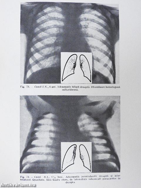 Tuberculoza Infantila