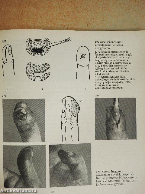 A kéz piogén fertőzései