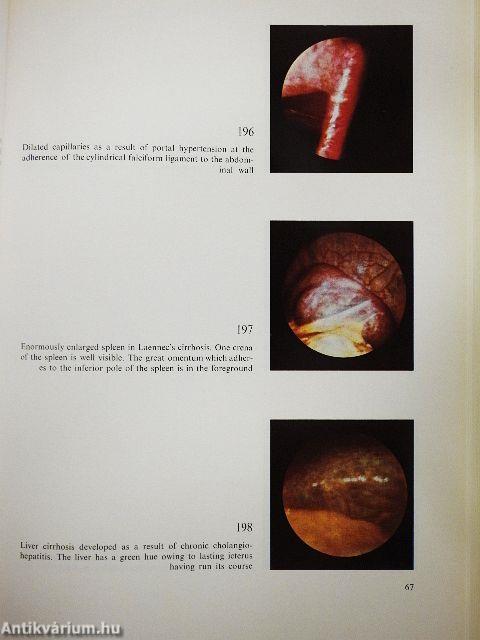 Peritoneoscopy 1-2.