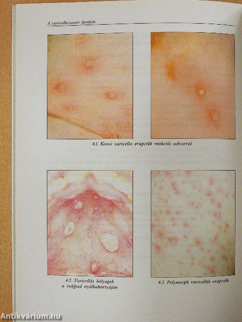 A varicella-zoster fertőzés