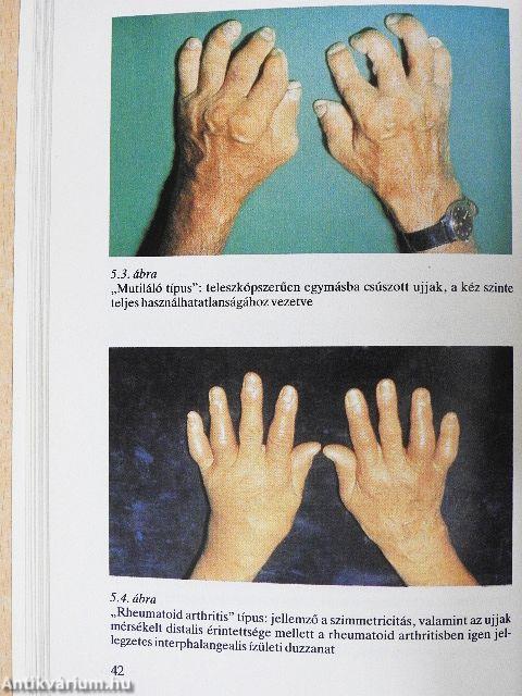 Arthritis psoriatica