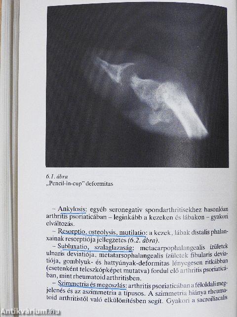 Arthritis psoriatica