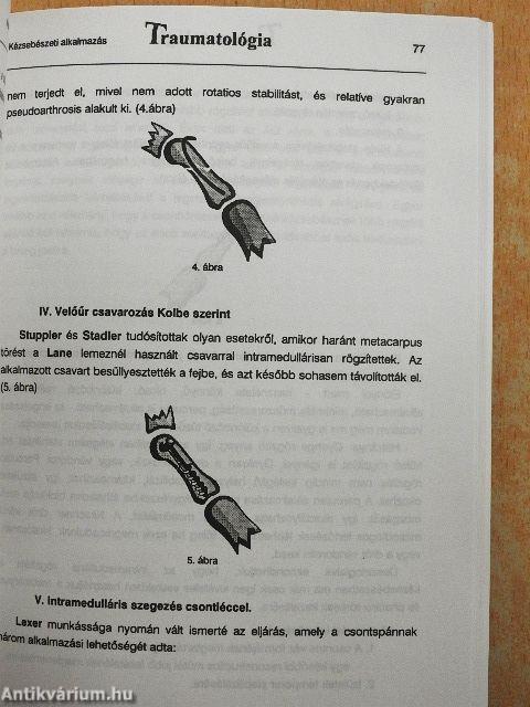 Intramedulláris rögzítés