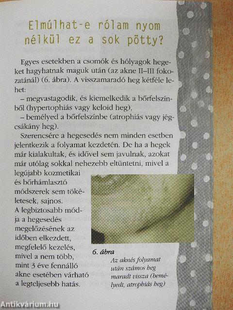 Amit a pattanásról tudni kell!