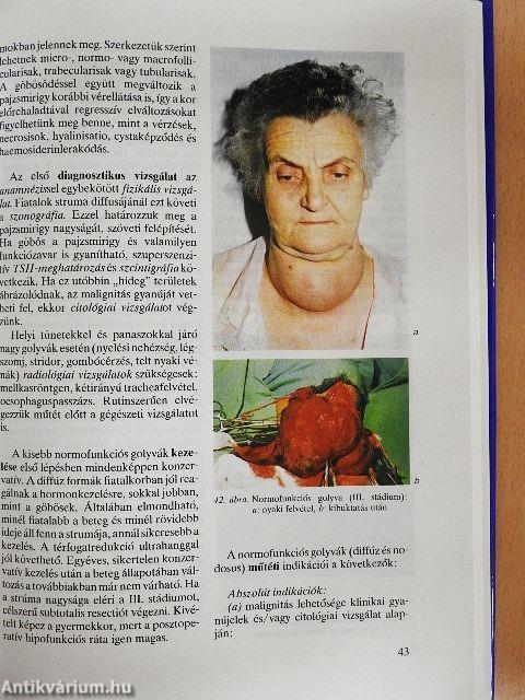 A pajzsmirigy és a mellékpajzsmirigy sebészete