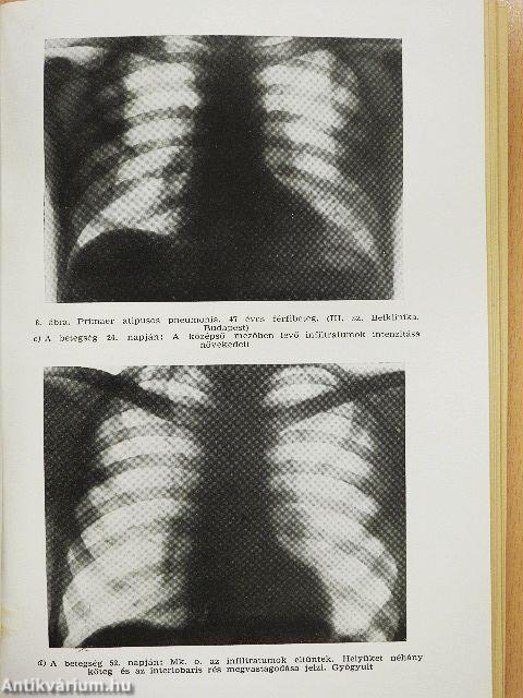 Újabb fertőző betegségek