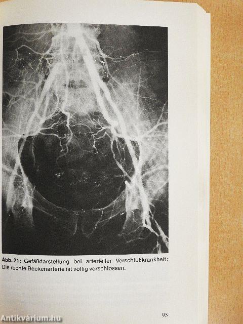 Herzinfarkt