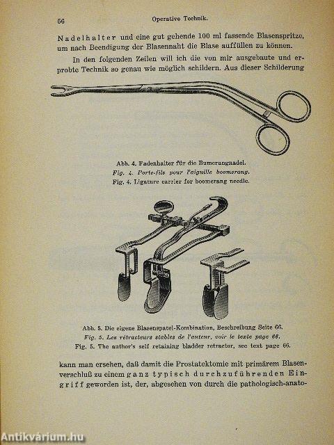 Die Suprapubische Prostatektomie