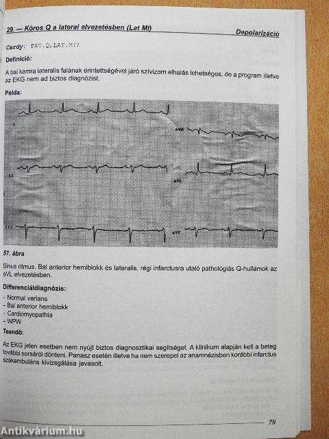 EKG súgó