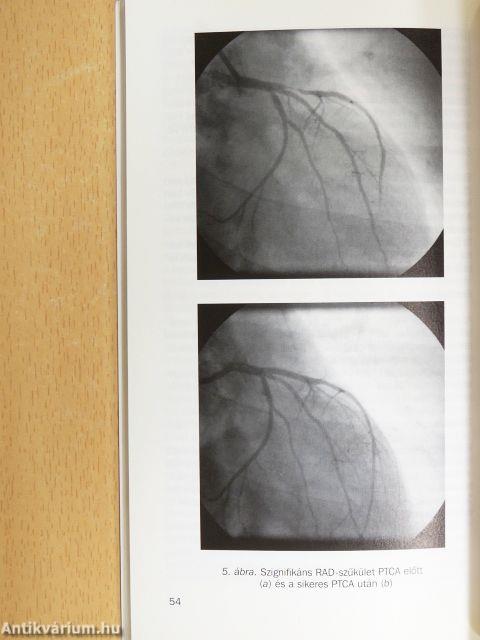 Angina pectoris