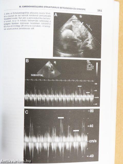 Syncope