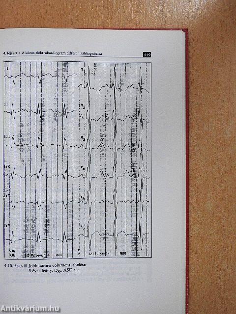 EKG a gyermekkorban