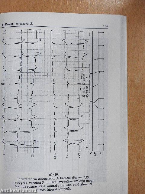 EKG lépésről-lépésre