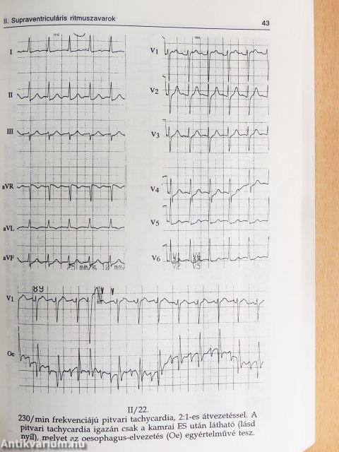 EKG lépésről-lépésre