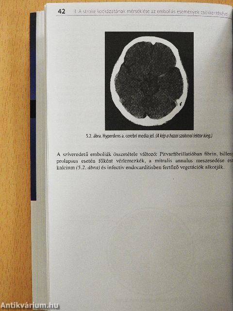 Stroke-prevenció