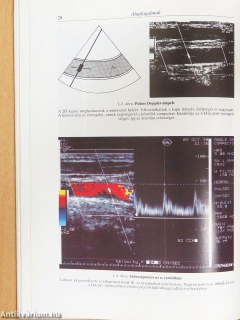 Duplex ultrahang