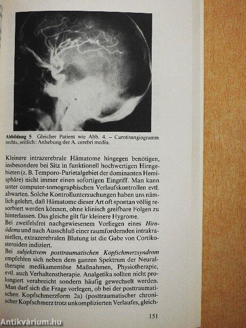 Kopfschmerz