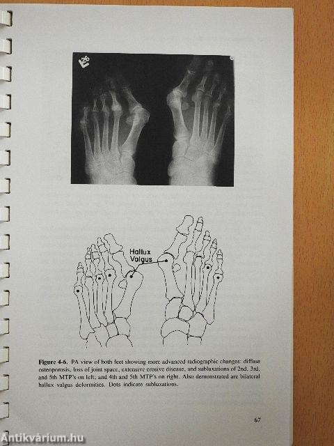 Rheumatoid Arthritis