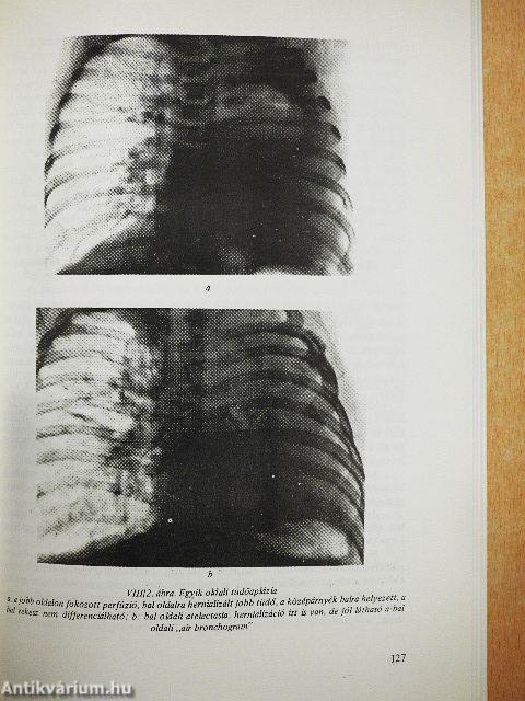 A tüdő röntgendiagnosztikája