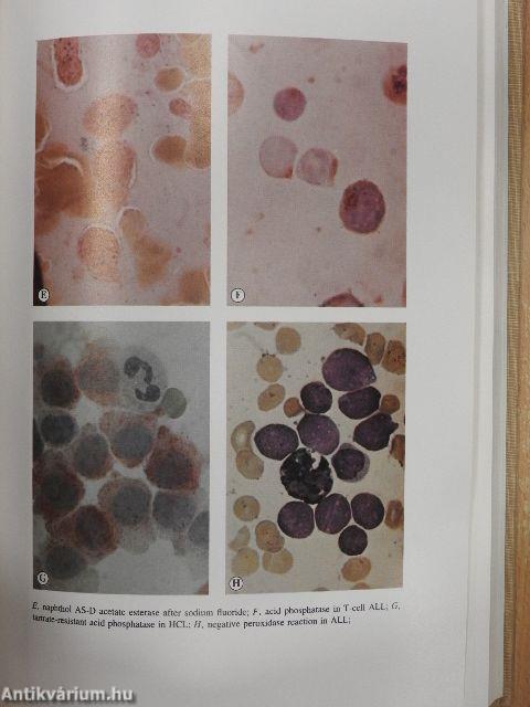 Leukemia