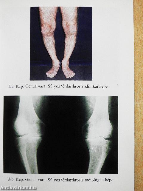 Arthrosis a mindennapi gyakorlatban