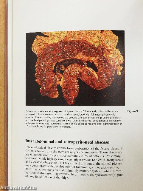 Inflammatory Bowel Disease