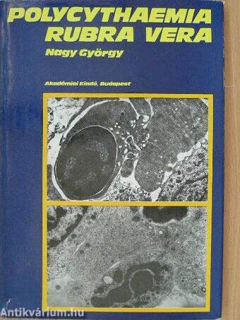 Polycythaemia rubra vera klinikuma, pathologiája és korszerű kezelése