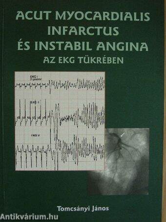 Acut myocardialis infarctus és instabil angina az EKG tükrében