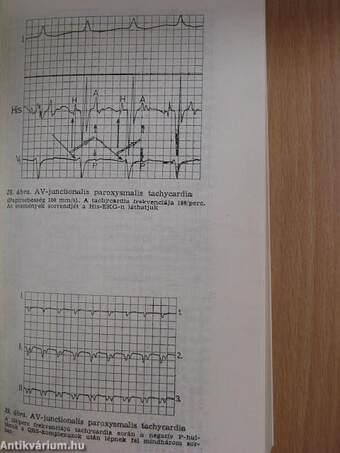 A ritmuszavarok diagnózisa és terápiája